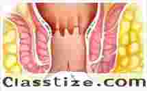 Expert Fissure Surgeon in Kolkata for Advanced Care