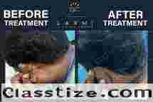  Effective Vitiligo & Leucoderma Cure