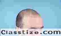 Best Hair Transplant in Chhattisgarh | Saluja Skin Clinic