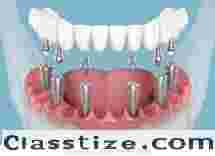 Restore Your Smile with Advanced Dental Implant Care