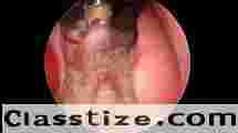 Adenoidectomy By Coblation