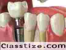 Smile Confidently with Dental Implant Clinic Chetla  