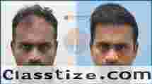 Hair Transplant Cost in Bhubaneswar | Alloroots 