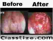 Coblator Assisted Adenoidectomy