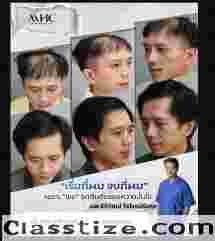 hair transplant