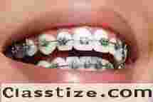 Expert Dental Braces Treatment Centre in Chetla  