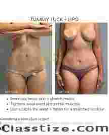 mommy makeover houston texas