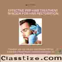 Effective PRP Hair Treatment In Noida For Hair Restoration