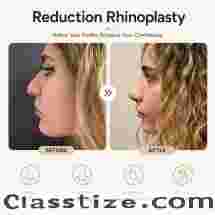 Nose Tip Reduction Cost and Reduction Rhinoplasty Options