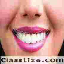 Best Smile designing clinic in Dubai UAE