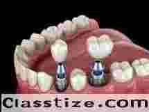 Restore Your Smile with Dental Implants Chetla  