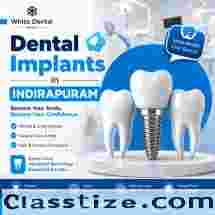 Dental Implants in Indirapuram for Permanent Tooth Replacement
