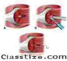 Find the Right Fissure Surgeon in Kolkata for better Treatment  