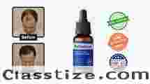 Does Regenixal work for all types of hair loss?
