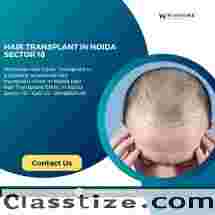 Hair Transplant in Noida Sector 18
