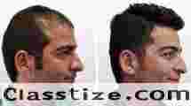 Best Hair Transplant in Pune| Clinique Intarnationale